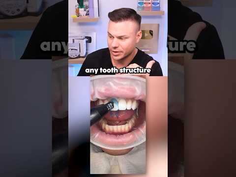 When Getting Veneers Goes WRONG! 😭🦷